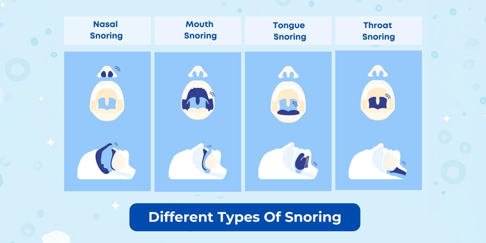 Types of snoring